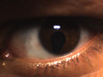 Left Iris Visible